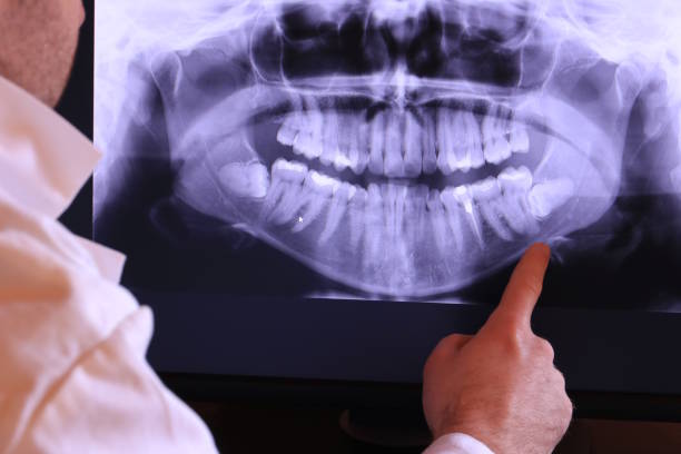 Best Emergency Wisdom Teeth Removal in St Anthony, MN
